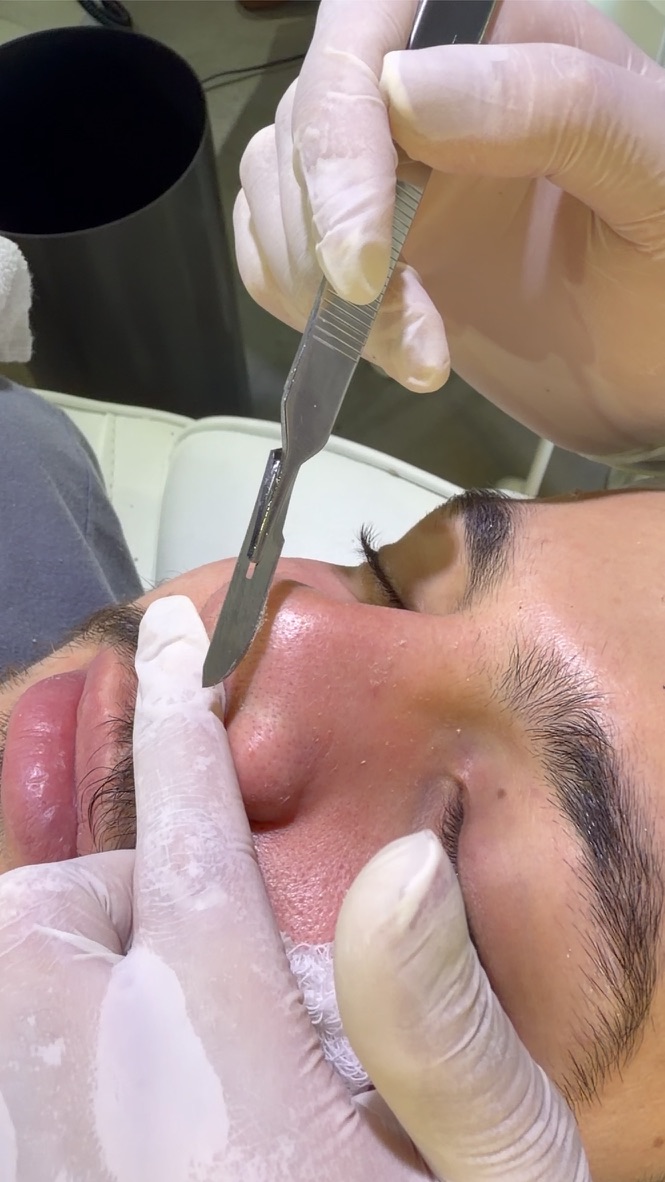 Aplicação da técnica com caneta de microagulhamento na pele de uma paciente