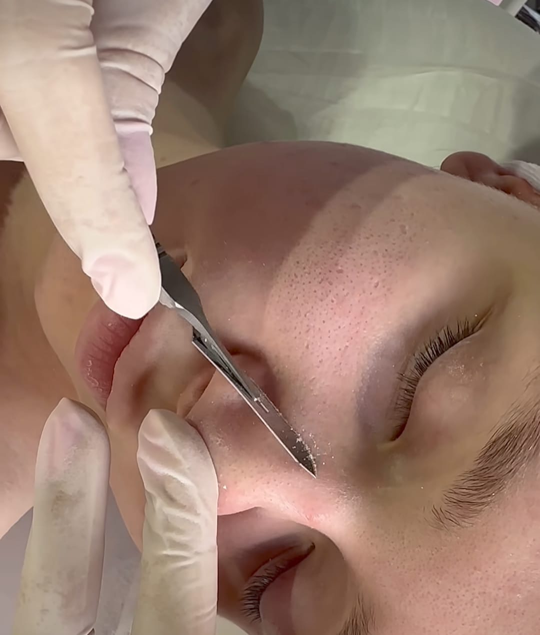 Close da aplicação do microagulhamento com caneta elétrica na pele de uma paciente